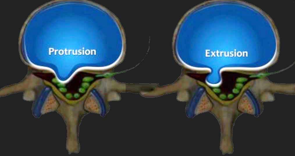 تفاوت بین Extrusion-protrusion