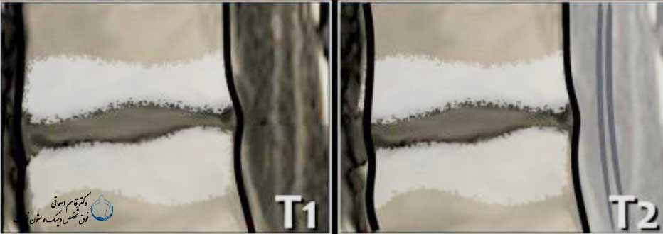 مودیک نوع 2 - فتق تنه مهره پس از بیماری دیسک