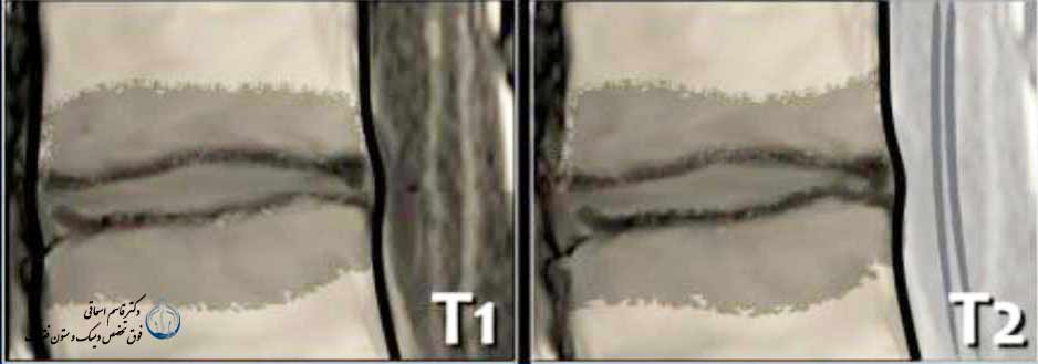 مودیک نوع 3 - فتق تنه مهره پس از بیماری دیسک