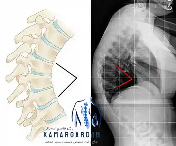 ورزش های قوز کمر یا کیفوز