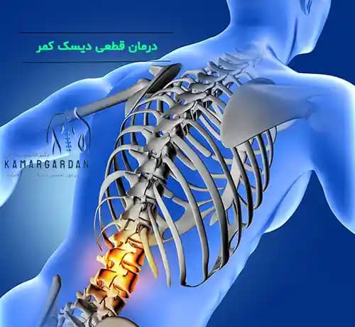 آیا درمان  قطعی برای دیسک وجود دارد ؟