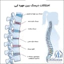 اختلالات دیسک بین مهره ای
