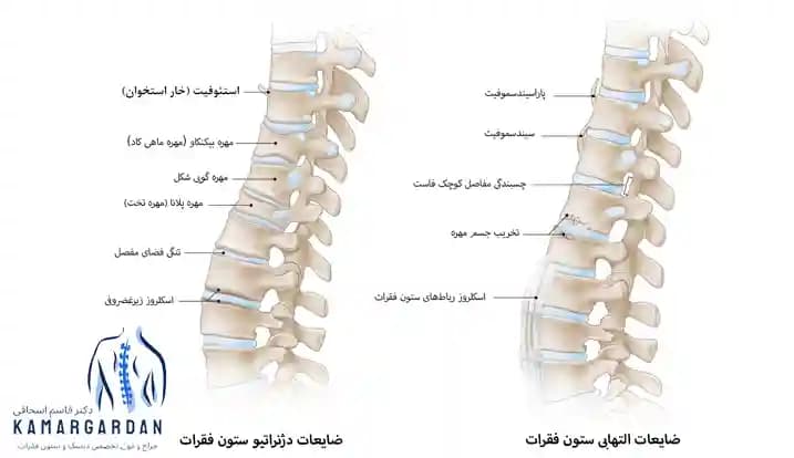 انواع بیماری دیسک کمر