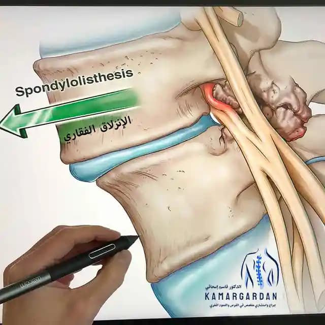 الإنزلاق الفقاري
