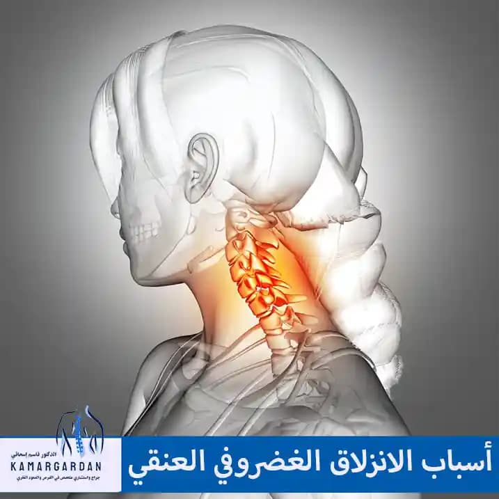 أسباب الانزلاق الغضروفي العنقي وكيفية معرفة ما إذا كنا نعاني من القرص العنقي؟
