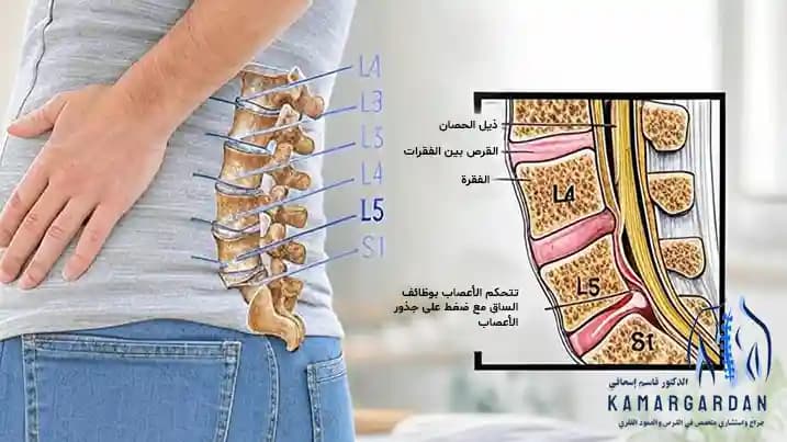 جراحة القرص L5 S1: حل لتقليل الألم وتحسين نوعية الحياة