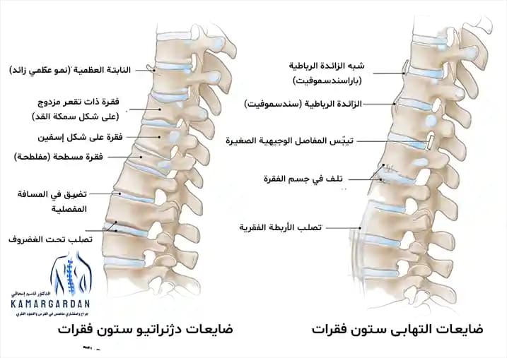 أنواع مرض القرص القطني