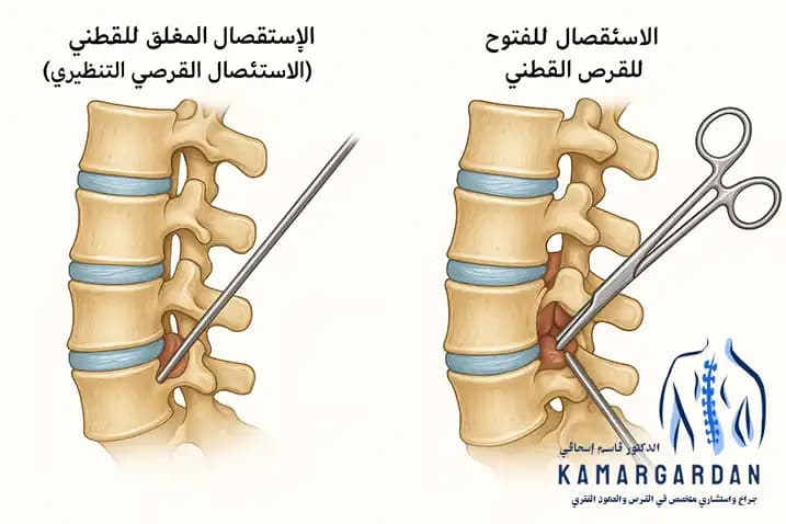 جراحة القرص الفقري