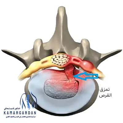 تمزق القرص القطني