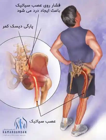 عصب سیاتیک و علت درد سیاتیک چیست؟ عصب سیاتیک و علت درد سیاتیک چیست؟