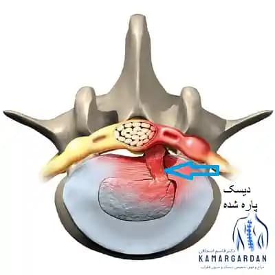 پارگی یا فتق دیسک کمر؛ از پیشگیری تا جدیدترین روشهای درمان پارگی یا فتق دیسک کمر؛ از پیشگیری تا جدیدترین روشهای درمان