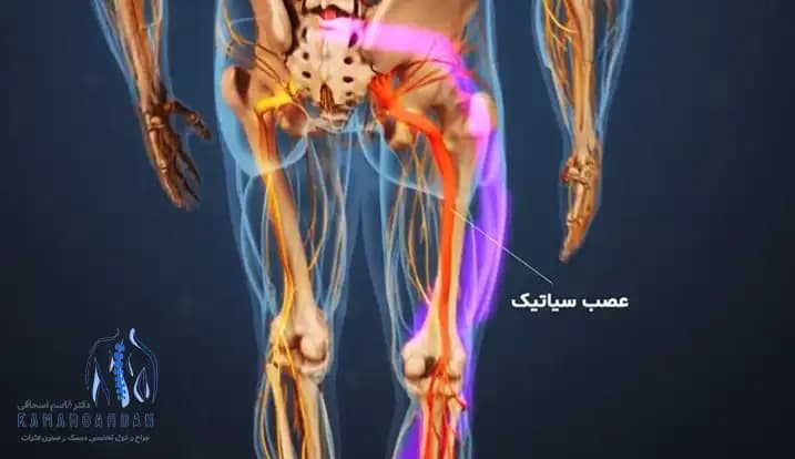 راههای تشخیص علت درد سیاتیک ( درد پای راست یا درد پای چپ ) چیست؟ راههای تشخیص علت درد سیاتیک ( درد پای راست یا درد پای چپ ) چیست؟