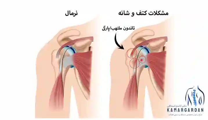 علت درد کتف و شانه چپ و روش های درمان علت درد کتف و شانه چپ و روش های درمان