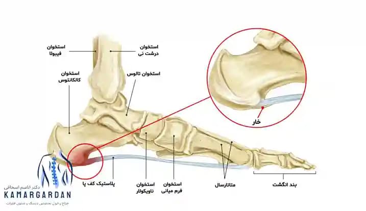 خار پاشنه علائم و راه های درمان خار پاشنه خار پاشنه علائم و راه های درمان خار پاشنه