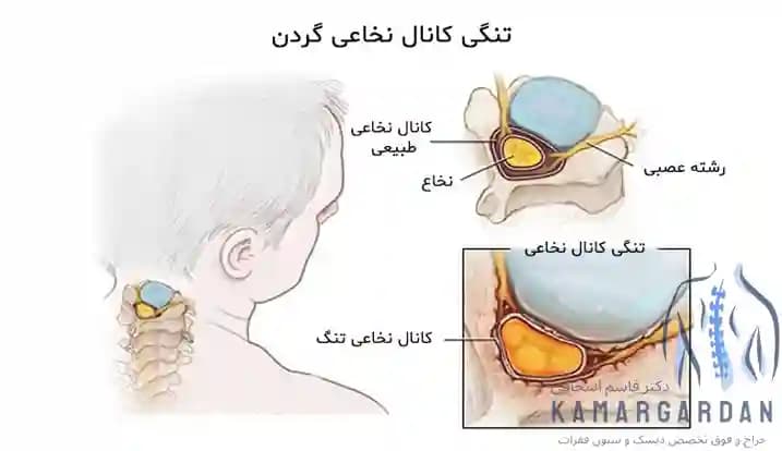 تنگی کانال نخاعی گردن تنگی کانال نخاعی گردن
