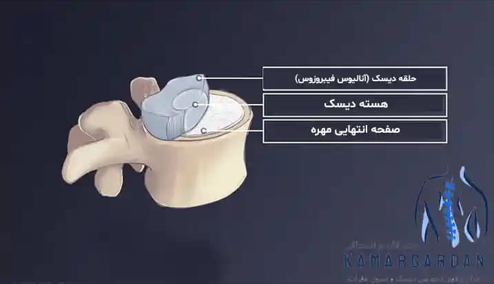 دیسک بین مهره ای دیسک بین مهره ای