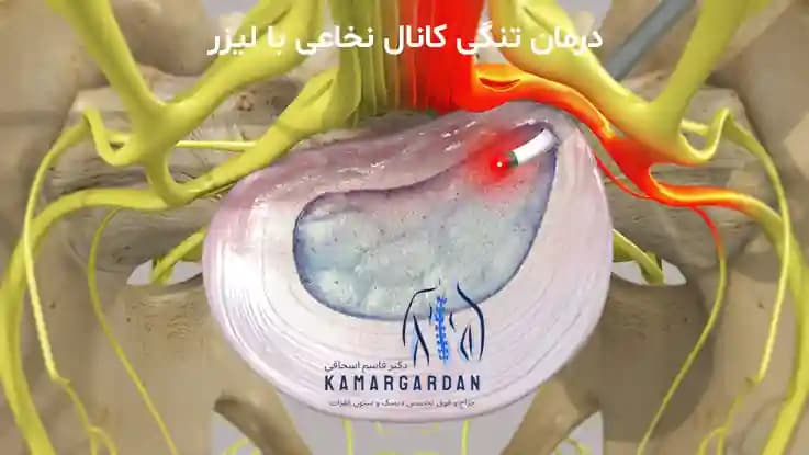 درمان تنگی کانال نخاعی با لیزر درمان تنگی کانال نخاعی با لیزر