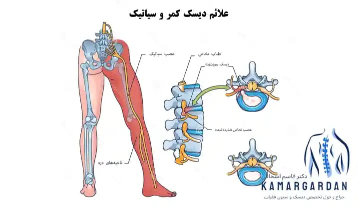 علائم دیسک کمر و سیاتیک: آشنایی با نشانهها و راههای درمان علائم دیسک کمر و سیاتیک: آشنایی با نشانهها و راههای درمان