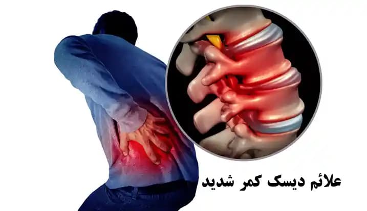 علائم دیسک کمر شدید: آنچه باید بدانید علائم دیسک کمر شدید: آنچه باید بدانید