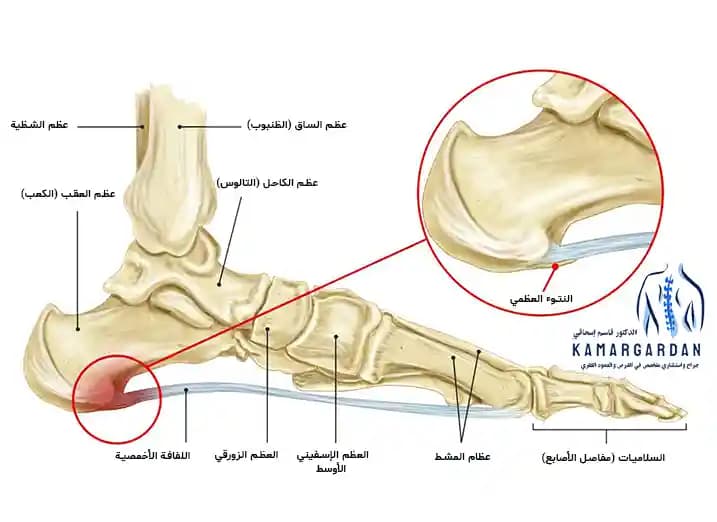 مهماز الكعب، أعراضه وطرق علاجه مهماز الكعب، أعراضه وطرق علاجه