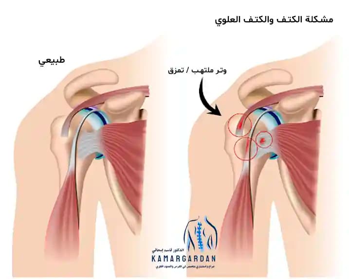 سبب آلام الكتف الأيسر والكتف وطرق العلاج سبب آلام الكتف الأيسر والكتف وطرق العلاج
