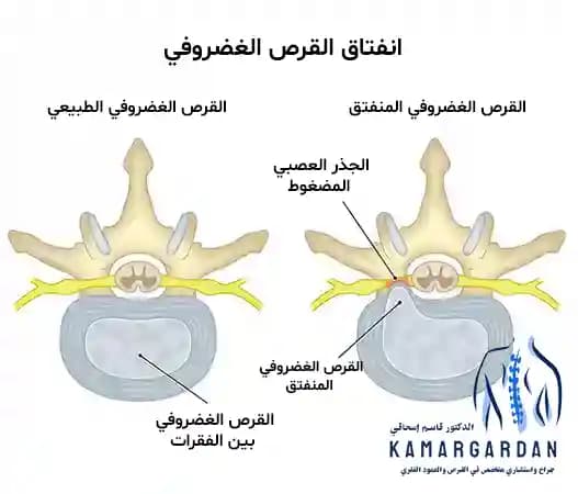 تمزق القرص العنقي وطرق العلاج الجديدة تمزق القرص العنقي وطرق العلاج الجديدة