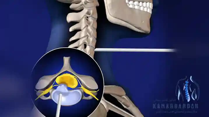 علاج وجراحة القرص العنقي بالليزر علاج وجراحة القرص العنقي بالليزر