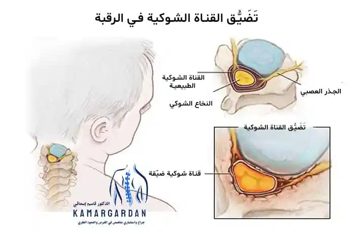 تضيق القناة الشوكية العنقية تضيق القناة الشوكية العنقية