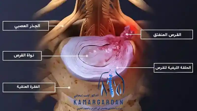 طرق جديدة لعلاج القرص العنقي طرق جديدة لعلاج القرص العنقي