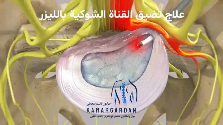 علاج تضيق القناة الشوكية بالليزر علاج تضيق القناة الشوكية بالليزر