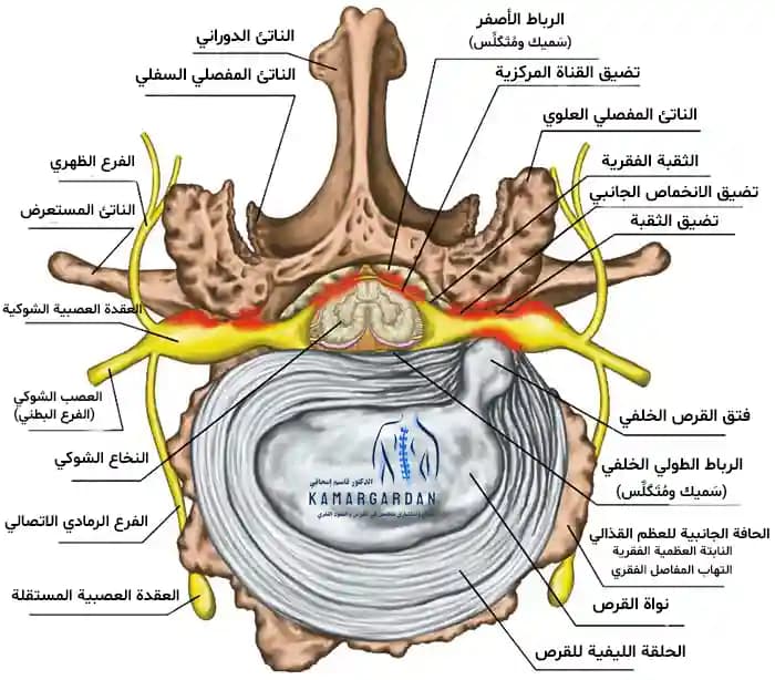 ضيق القناة الشوكية وطرق علاجه ضيق القناة الشوكية وطرق علاجه
