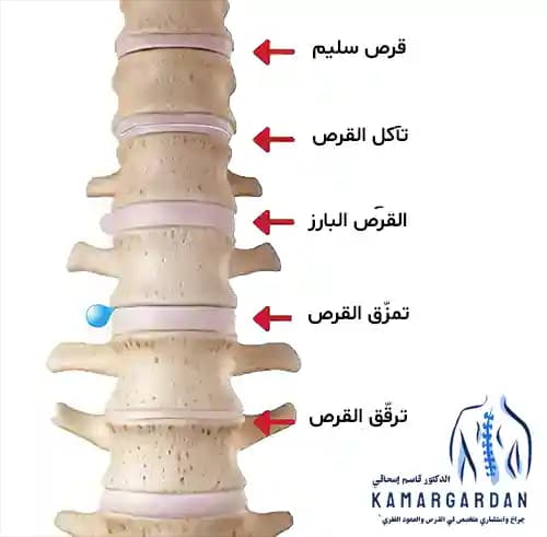 معالجة القرص القطني معالجة القرص القطني