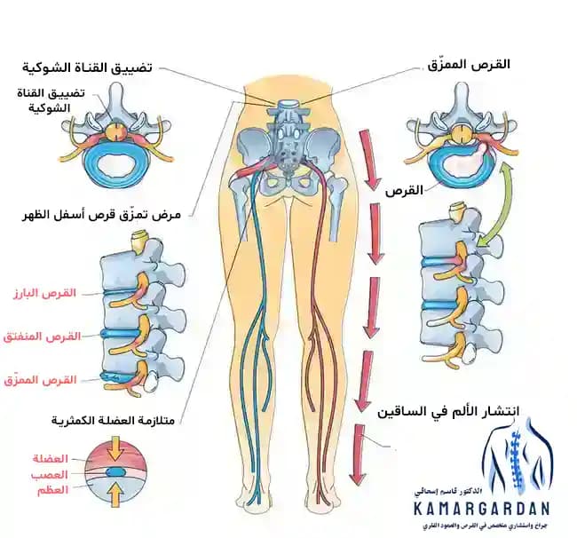 أعراض القرص القطني في الساقين: التعرف عليها وعلاجها أعراض القرص القطني في الساقين: التعرف عليها وعلاجها