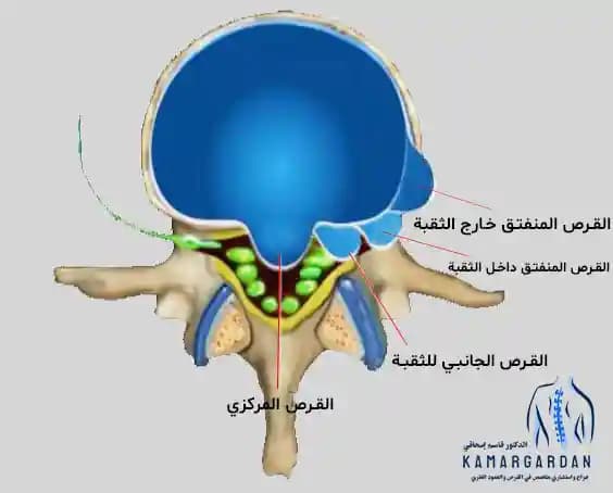 أنواع القرص القطني من حيث موقع التمزق أنواع القرص القطني من حيث موقع التمزق