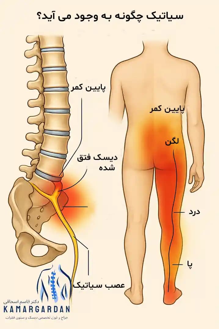 سیاتیک چگونه به وجود میآید؟ سیاتیک چگونه به وجود میآید؟