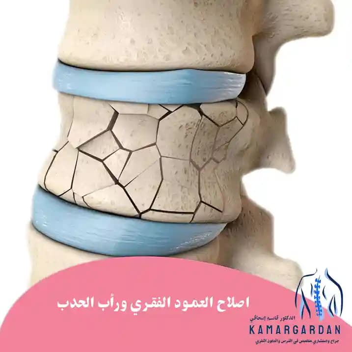 اصلاح العمود الفقري ورأب الحدب اصلاح العمود الفقري ورأب الحدب