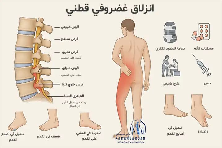 ما هي أعراض الانزلاق الغضروفي القطني والطرق الجديدة لعلاجه؟ ما هي أعراض الانزلاق الغضروفي القطني والطرق الجديدة لعلاجه؟