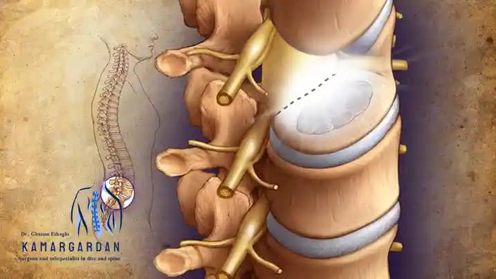 Laser Disc Surgery for the Spine Laser Disc Surgery for the Spine