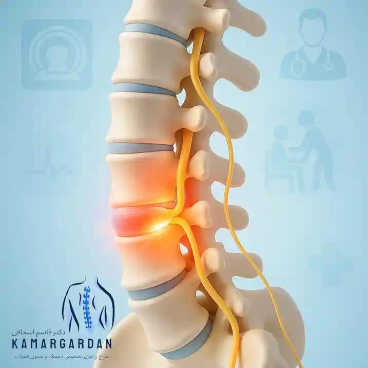 آیا پارگی دیسک کمر ترمیم میشود؟ آیا پارگی دیسک کمر ترمیم میشود؟